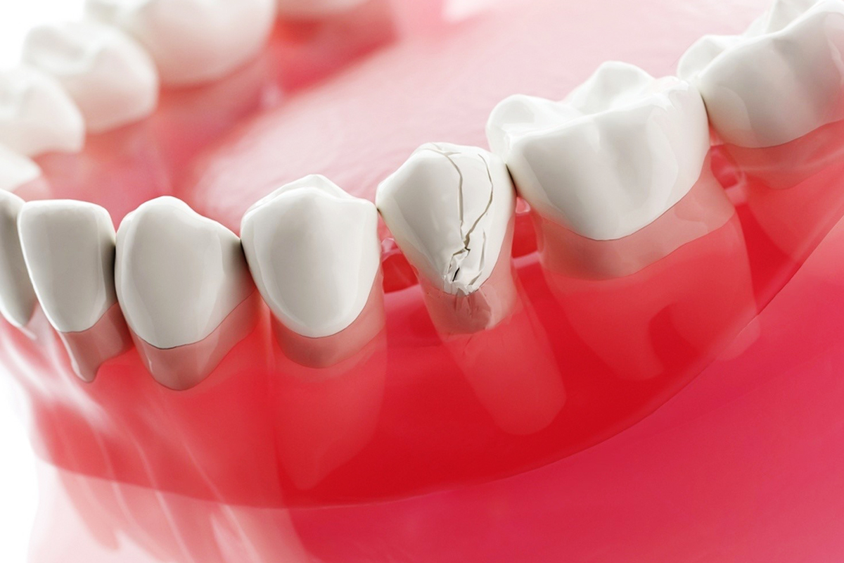 Fractured Tooth: What Are the Causes of This Dental Emergency?