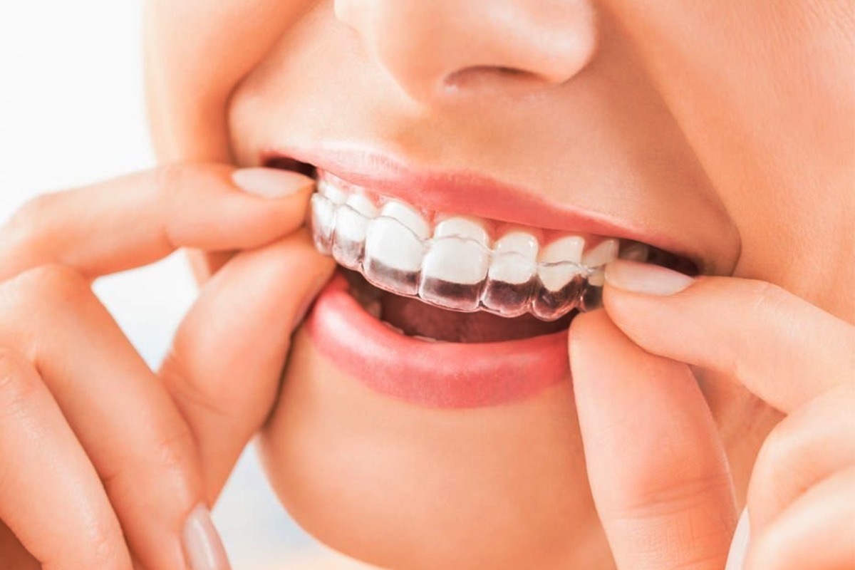 Clear Aligners vs Traditional Braces: Finding the Right Teeth-Straightening Solution