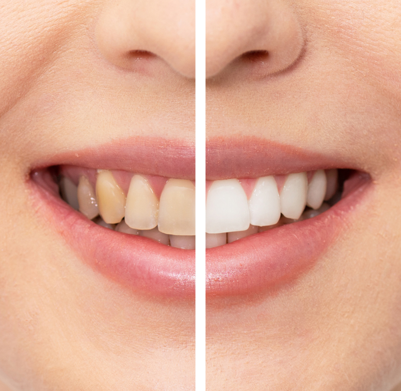 Teeth Whitening