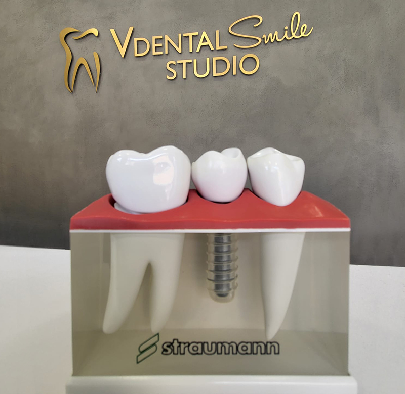 Dental Implants
