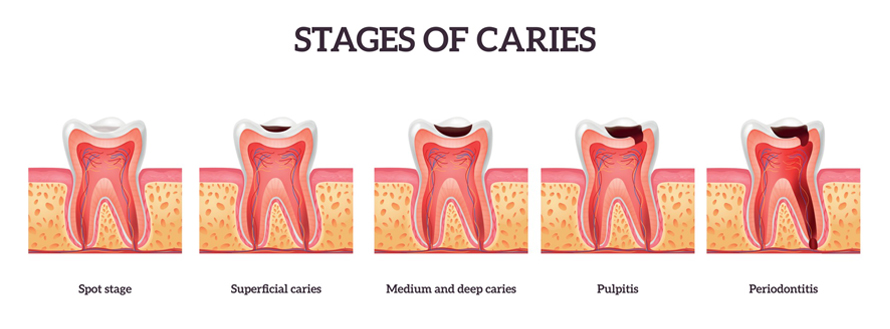 Stages of caries